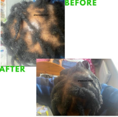 Hair Loss Prevention & Cure (2022 Update!)