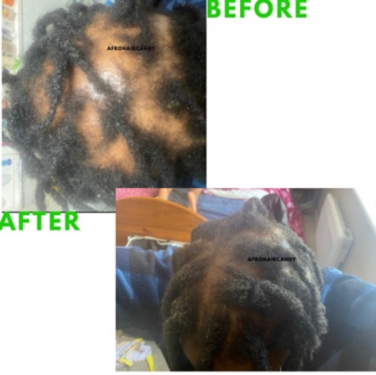 Hair Loss Prevention & Cure (2022 Update!) AfroHairCandy