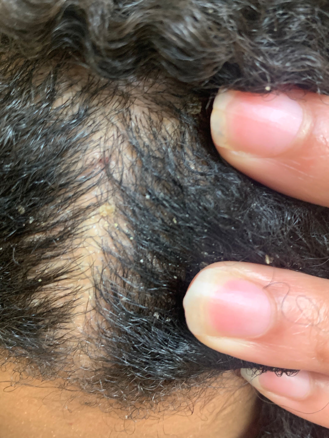 Dermatitis: Types, Causes, Treatments & Symptoms (Most Underestimated Skin Disease) AfroHairCandy
