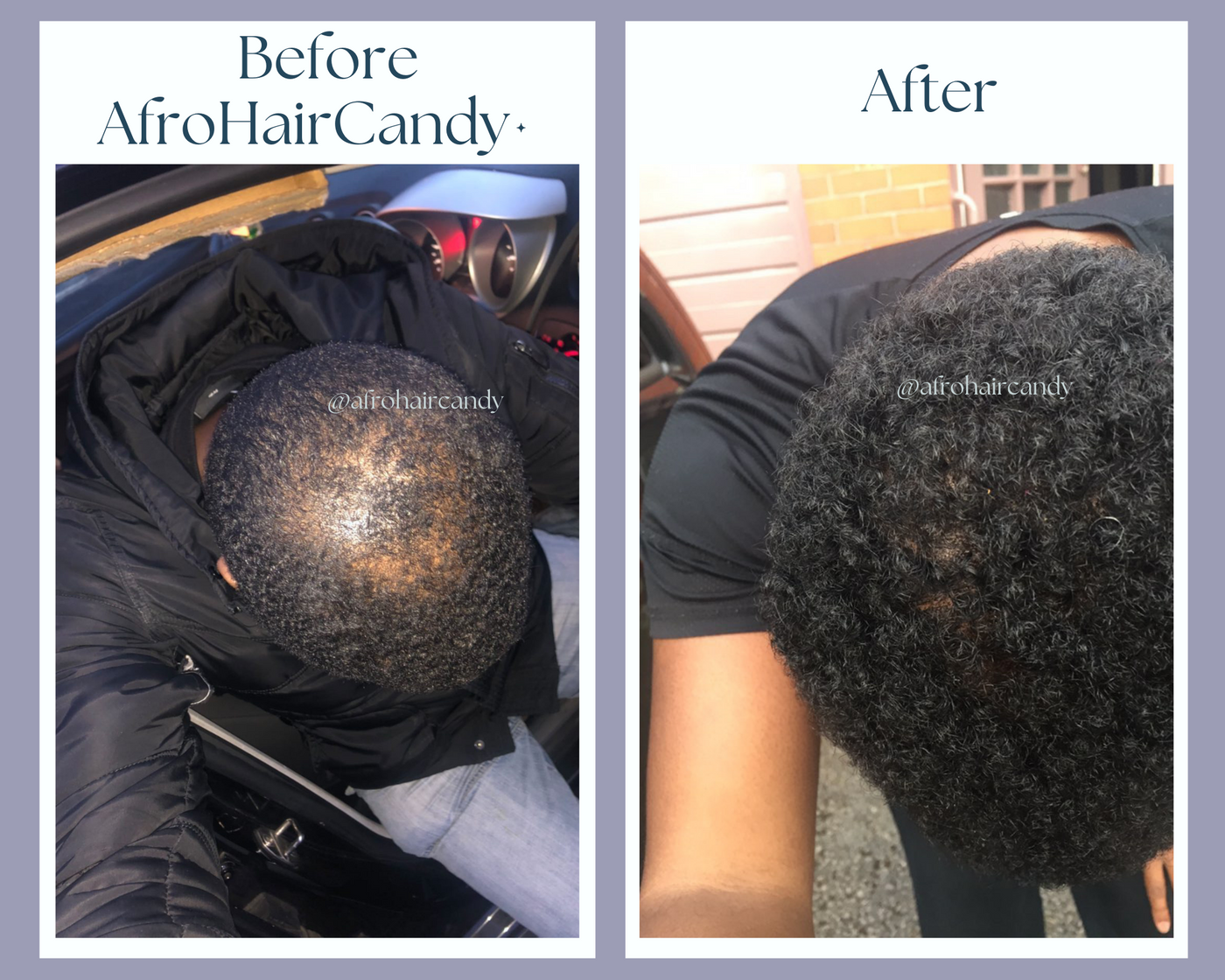 Hair Loss Prevention & Cure For Our Men AfroHairCandy