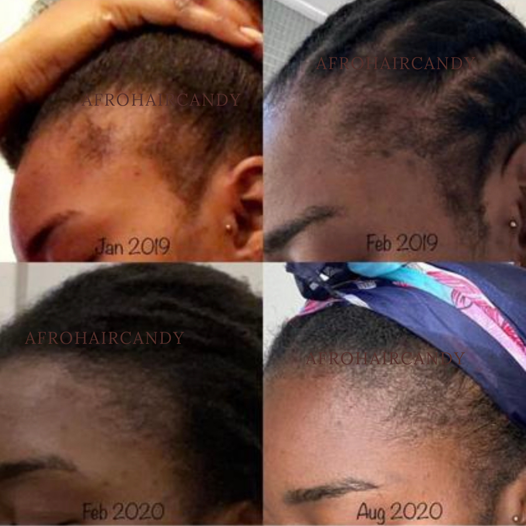 The Weird Secret To Fuller Edges Explained. AfroHairCandy