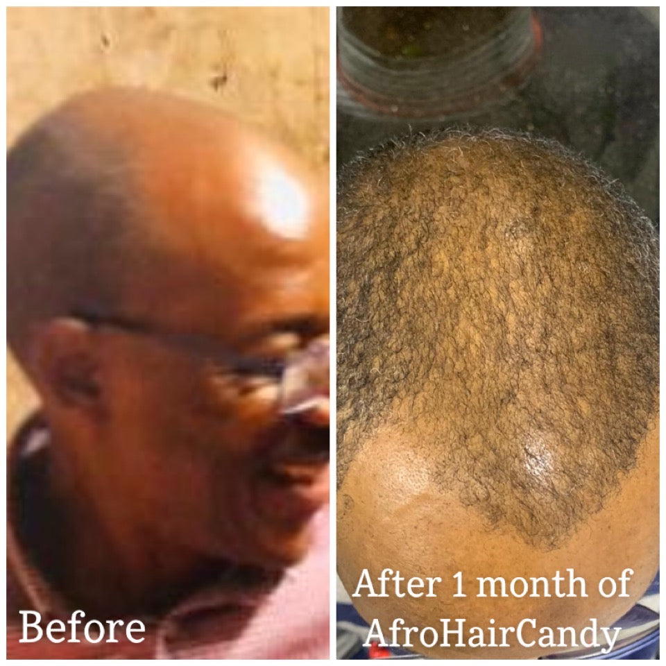 Male Hair Loss Treatment