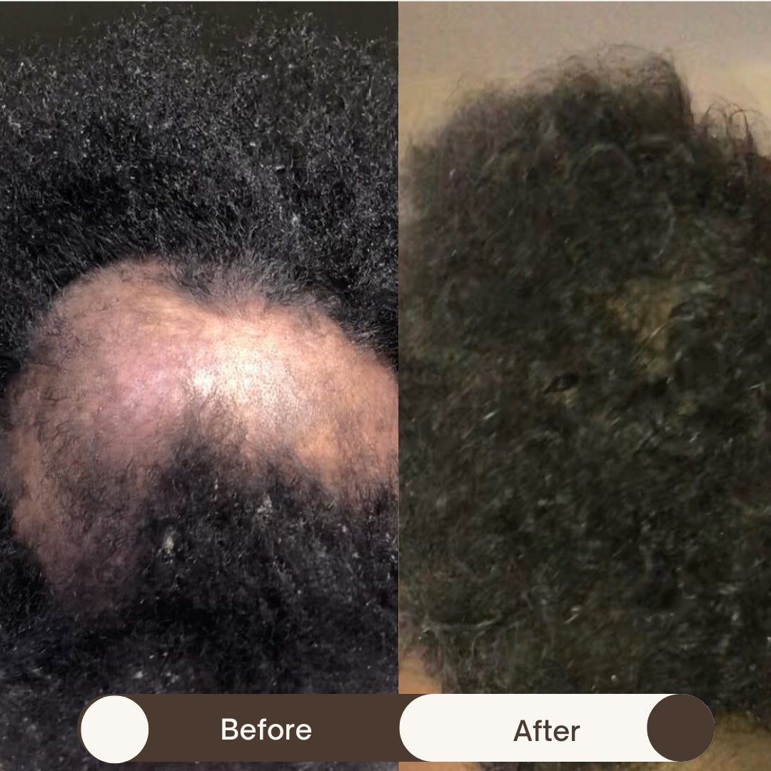 Hair Loss
