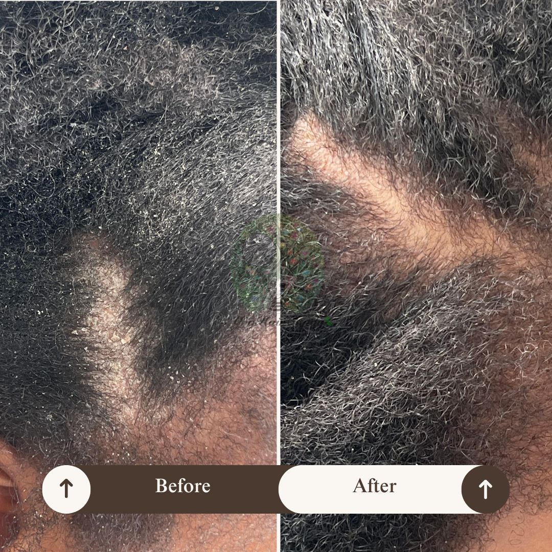 Scalp Care