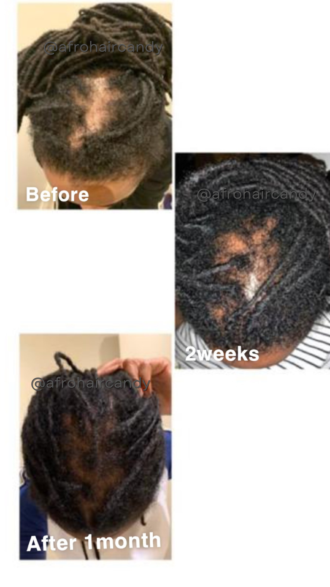 Locs & Sisterlocs Hair Loss Recovery Set