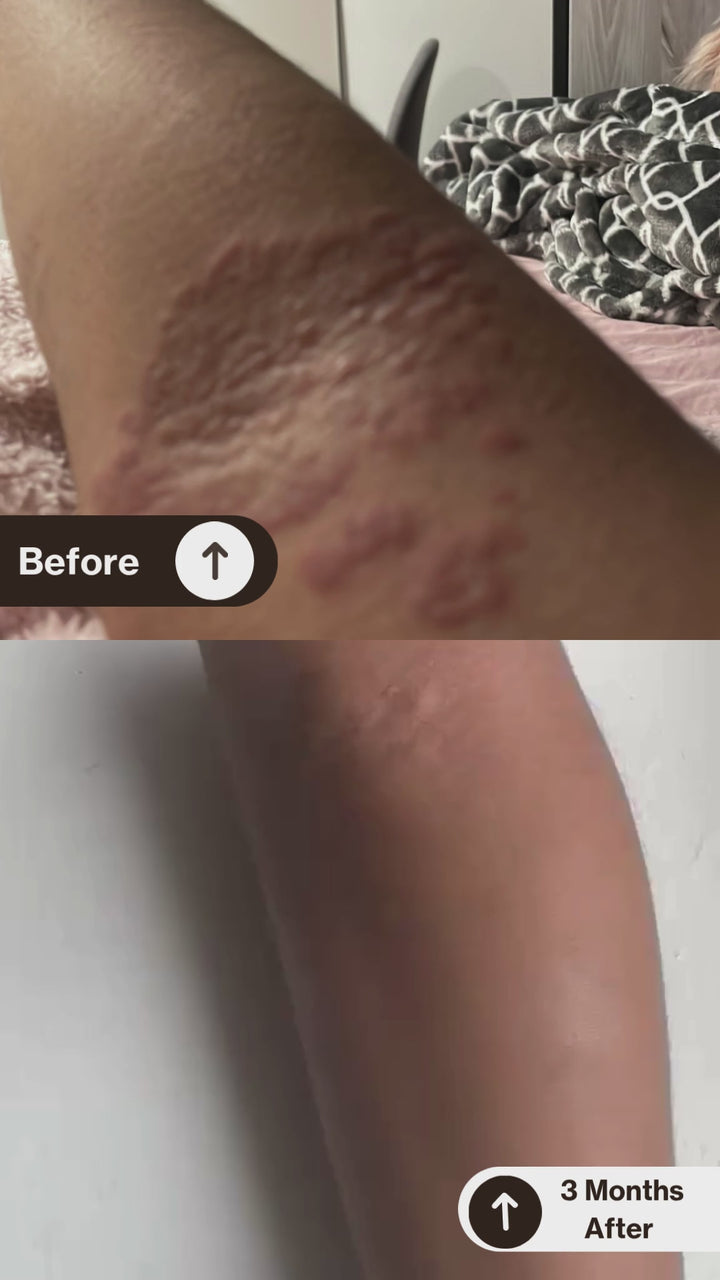 Adult Eczema Recovery System