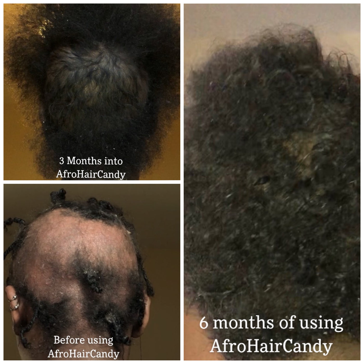 SET OF 5 -Hair Loss Recovery For Women